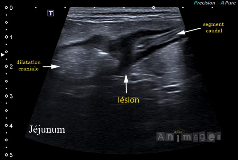 échographie: lésion jéjunale