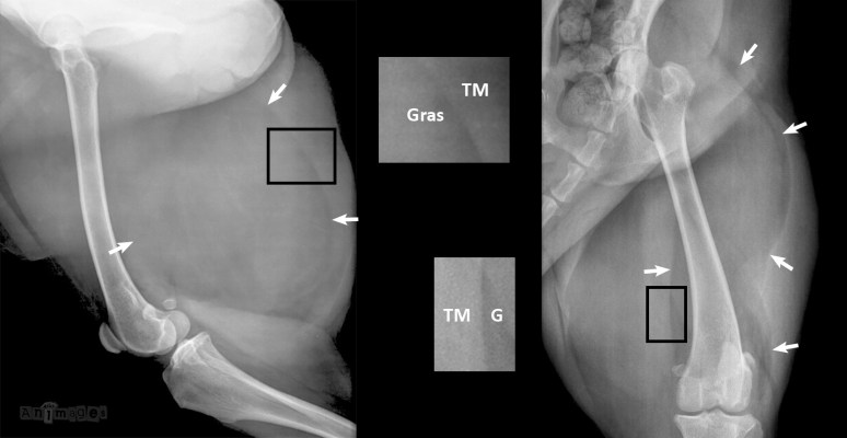 lipome intermusculaire RADIO