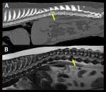 Comparaison CT-MR hernie type&nbsp;I