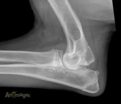 Latérale en semi-flexion