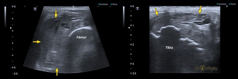 sarcome synoviale_echo