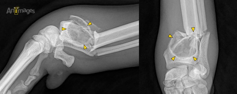 kyste osseux fracture pathologique_annot